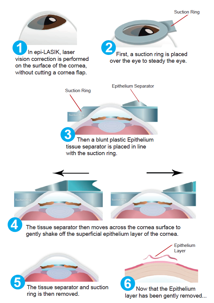 Epi lasik store